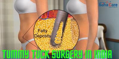 tummy tuck in india | EduCare